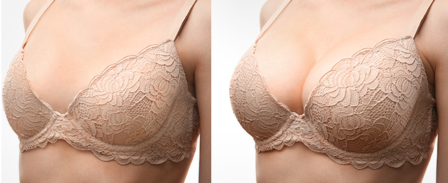 Loss of Breast Volume After Pregnancy? Consider A Breast Augmentation